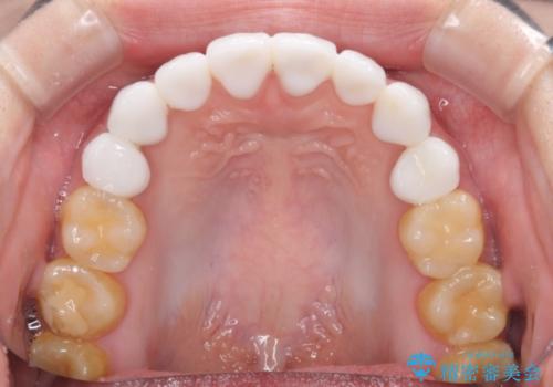 とにかく歯を白くしたい　前歯の審美歯科治療の治療後