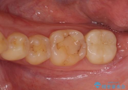 左下奥歯 歯肉の少し下まで虫歯 セラミック治療の治療後