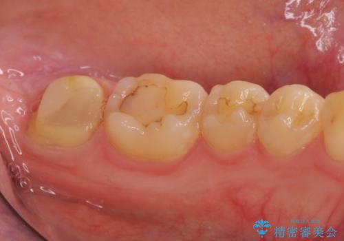 左下奥歯 歯肉の少し下まで虫歯 セラミック治療の治療中