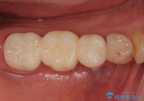歯が割れている　オールセラミックによる奥歯のブリッジの症例 治療後