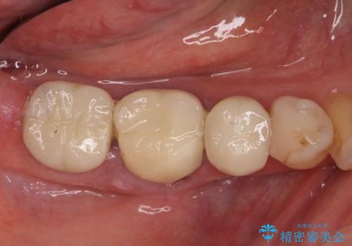 歯が割れている　オールセラミックによる奥歯のブリッジの症例 治療前