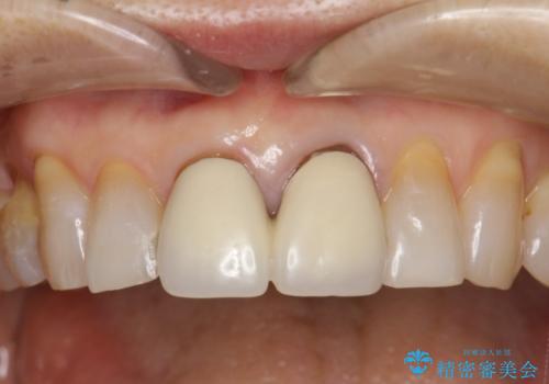 前歯のオールセラミックやり替え　複雑な色味を再現するの症例 治療前