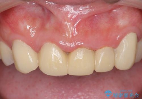 オールセラミッククラウンによる前歯部の補綴の治療前