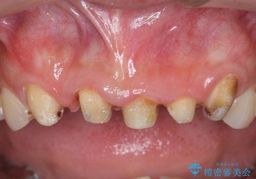 オールセラミッククラウンによる前歯部の補綴の治療前