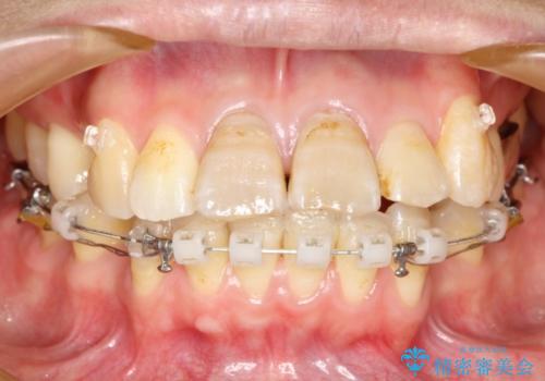 コルチコトミーを併用した上下出っ歯の抜歯矯正の治療中
