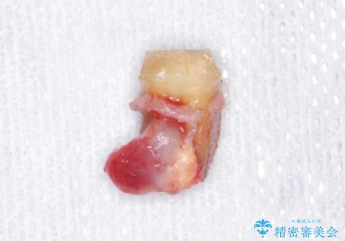 歯に穴が開いている　抜歯してインプラントへ　30代男性の治療前