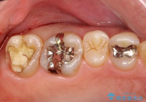 奥歯の詰め物が外れてしまった　金合金による修復の治療前