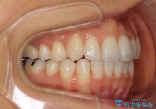 マウスピースで上下の歯のでこぼこを解消　インビザラインの治療中