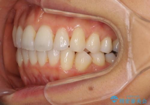 マウスピースで上下の歯のでこぼこを解消　インビザラインの治療中