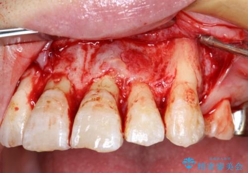 コルチコトミーを併用した上下出っ歯の抜歯矯正
