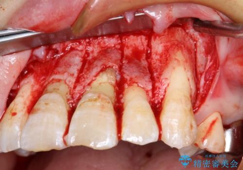 コルチコトミーを併用した上下出っ歯の抜歯矯正の治療中