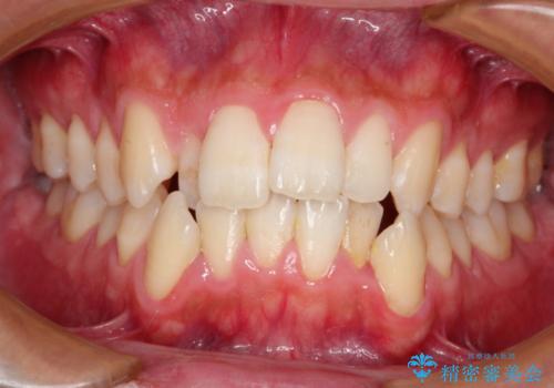 前歯のでこぼこをスッキリと　目立たない装置による抜歯矯正の治療前