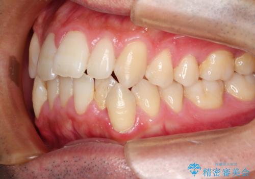 前歯のでこぼこをスッキリと　目立たない装置による抜歯矯正の治療前
