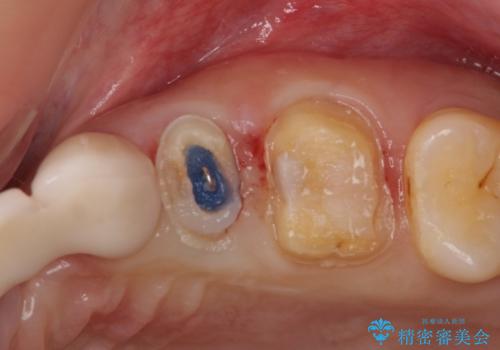 歯茎の中にまで及んだ大きなむし歯　抜歯をせずにセラミッククラウンにの治療中