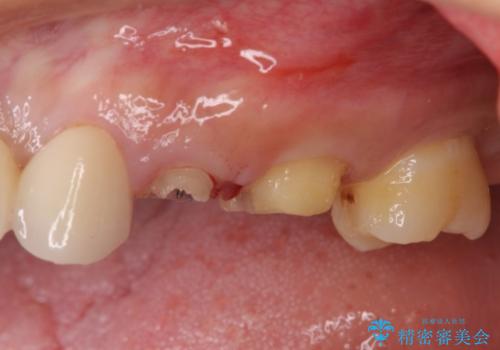 歯茎の中にまで及んだ大きなむし歯　抜歯をせずにセラミッククラウンにの治療中
