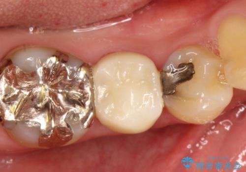 銀歯の下に2次的な虫歯が　土台からのやり直しの治療後