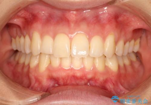 出っ歯が気になり笑えない インビザラインで出っ歯の治療の治療後