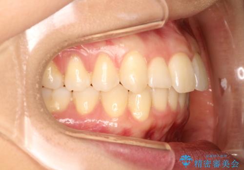 出っ歯が気になり笑えない インビザラインで出っ歯の治療の症例 治療後