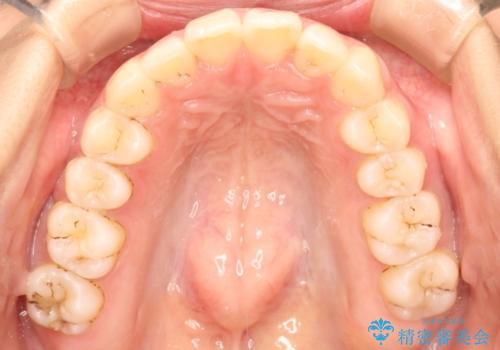出っ歯が気になり笑えない インビザラインで出っ歯の治療の治療後