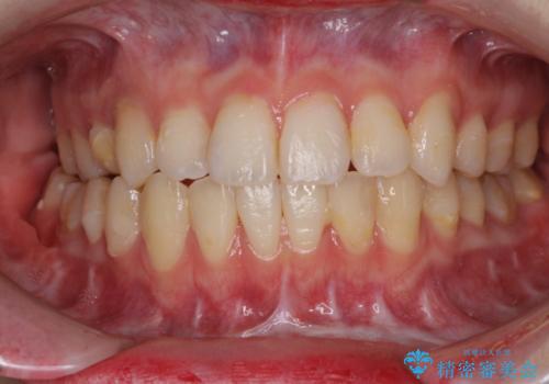 とにかく歯を白くしたい　前歯の審美歯科治療の症例 治療前