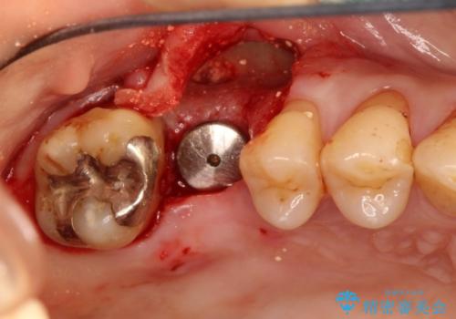上の奥歯が抜歯になってしまった　インプラントによる修復の治療中