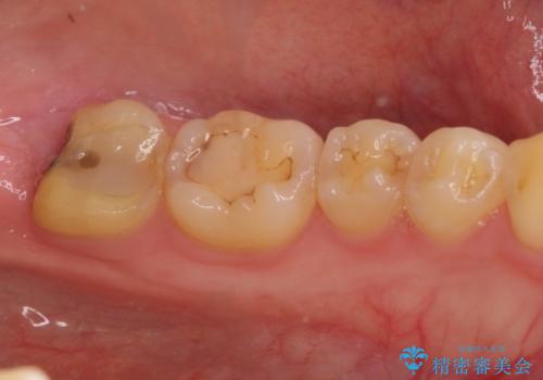 左下奥歯 歯肉の少し下まで虫歯 セラミック治療の治療前