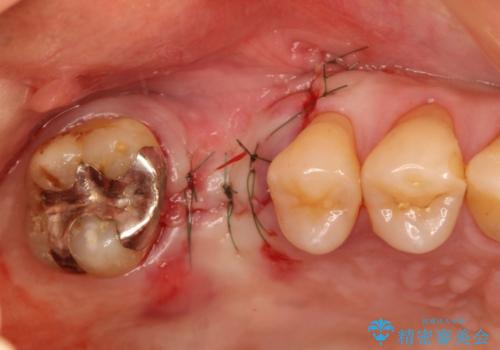 上の奥歯が抜歯になってしまった　インプラントによる修復の治療中