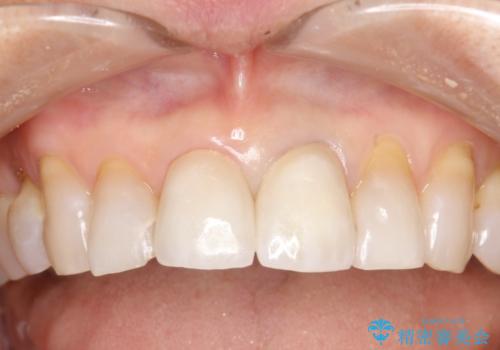 前歯のオールセラミックやり替え　複雑な色味を再現するの症例 治療後