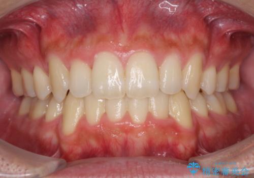 前歯のでこぼこをスッキリと　目立たない装置による抜歯矯正