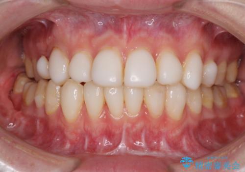 とにかく歯を白くしたい　前歯の審美歯科治療の治療中