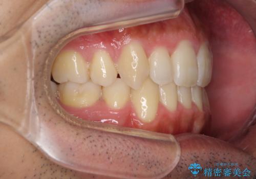 前歯のでこぼこをスッキリと　目立たない装置による抜歯矯正の治療後