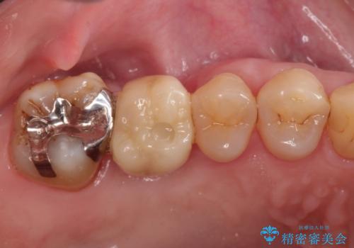 上の奥歯が抜歯になってしまった　インプラントによる修復の治療後