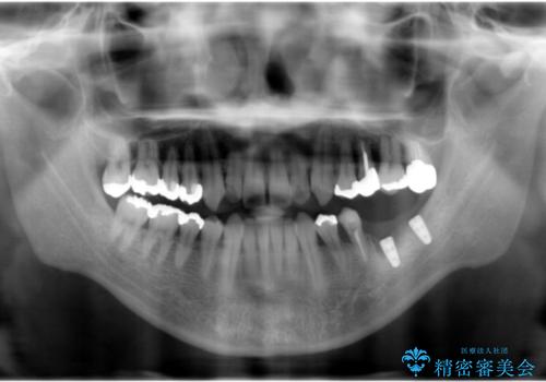 歯に穴が開いている　抜歯してインプラントへ　30代男性の治療中
