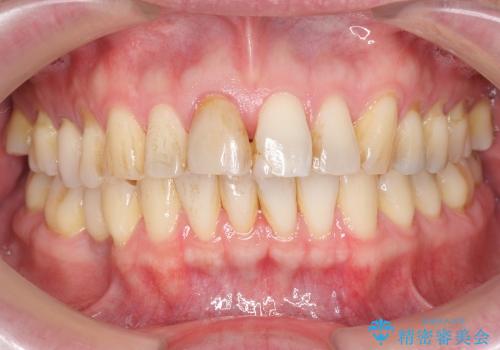 神経の死んだ歯の変色　前歯審美回復セラミック治療の治療前
