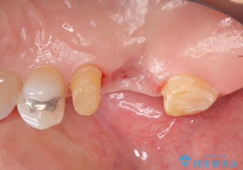 歯周外科を行い清掃性を高めた臼歯部ブリッジ治療の治療前