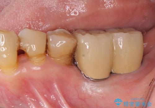 [ 骨造成を伴う臼歯部インプラント治療 ② ]  歯ぐきの移植・チタンカスタムアバットメント・メタルボンドクラウン製作の治療後