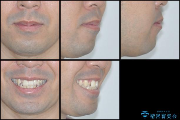 前歯のでこぼこをスッキリと　目立たない装置による抜歯矯正の治療前（顔貌）
