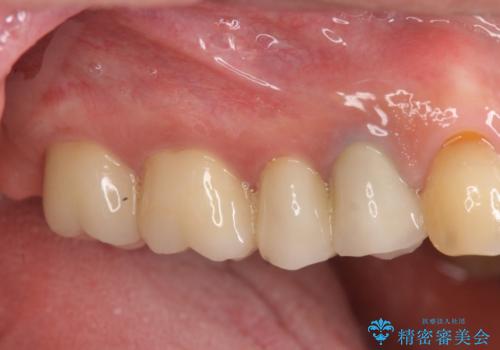 [ジルコニアクラウン] 銀歯を白く　臼歯部メタルフリー治療の治療後