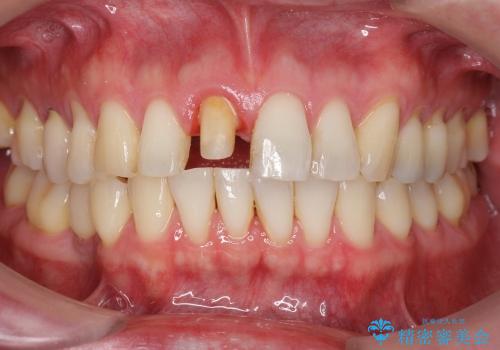 神経の死んだ歯の変色　前歯審美回復セラミック治療の治療中