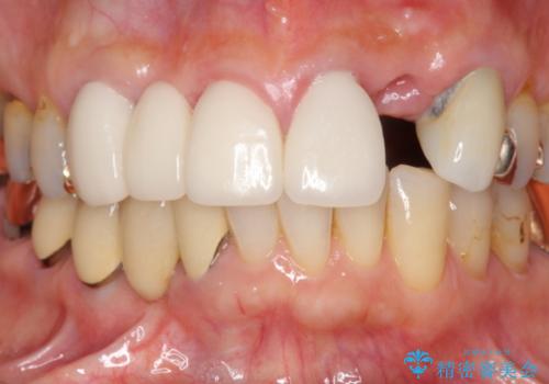 歯周環境の整備を行った前歯部ブリッジ治療の治療前