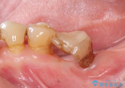 [ 骨造成を伴う臼歯部インプラント治療 ① ]  抜歯を行い骨造成、インプラントの埋入の症例 治療前