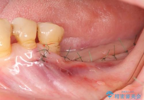 [ 骨造成を伴う臼歯部インプラント治療 ① ]  抜歯を行い骨造成、インプラントの埋入の治療後
