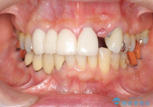 歯周環境の整備を行った前歯部ブリッジ治療の治療前