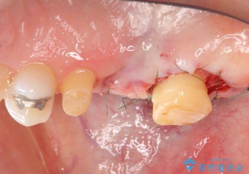 歯周外科を行い清掃性を高めた臼歯部ブリッジ治療の治療中
