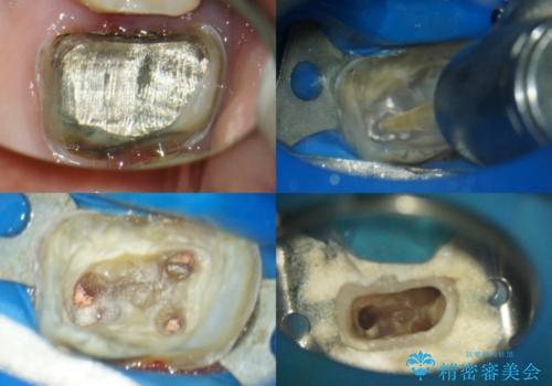 2次的な虫歯になった金属の被せもののやり直しの治療中