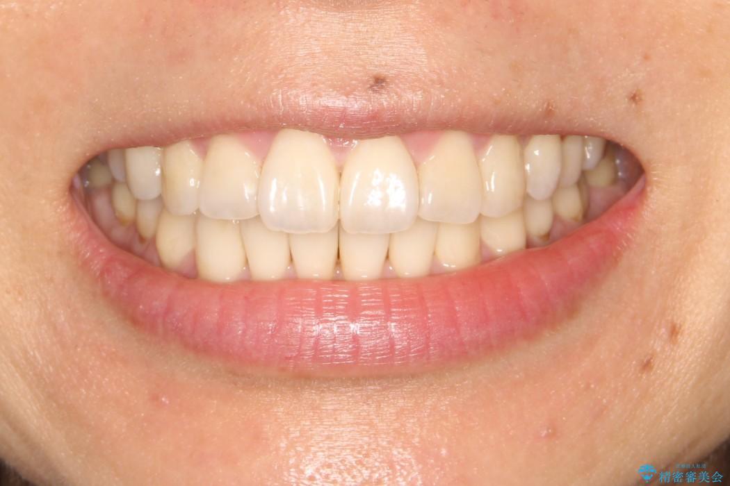 インビザライン・非抜歯　出っ歯とガタつきの矯正治療の治療後（顔貌）