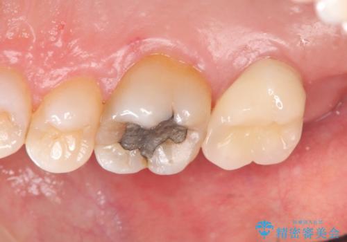 [骨縁に達する深い虫歯] 歯の挺出・歯周外科を応用し抜かずに残す治療②の治療後