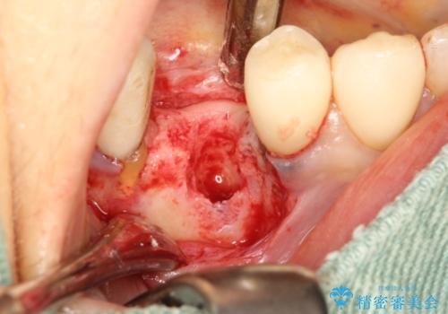歯根破折で抜歯を余儀なくされた歯のインプラント治療の治療中