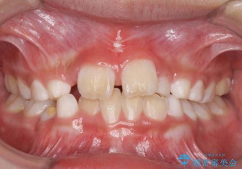子どもの治療　すきっ歯を防止する予防治療　上唇小帯切除の治療後
