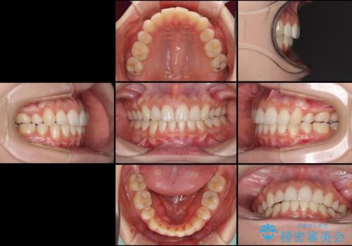 前歯の反対咬合を改善　フルリンガルの抜歯矯正の治療後